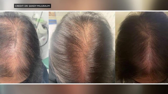 Three photos showing a patient with pattern hair loss regrowing hair after receiving treatment. 